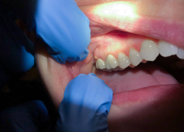 Best Emergency Tooth Extraction  in Palestine, IL